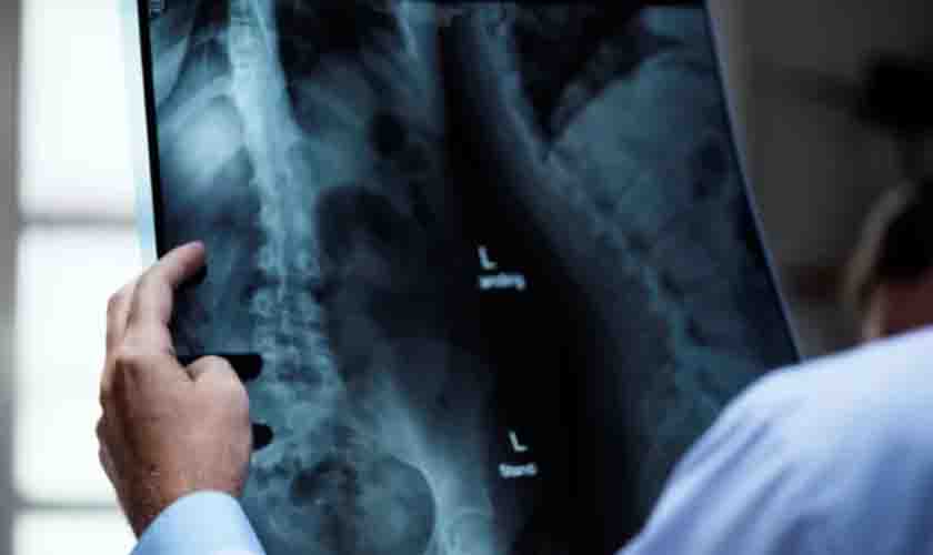 Abril Amarelo mostra a médicos melhor conduta para tratar câncer ósseo