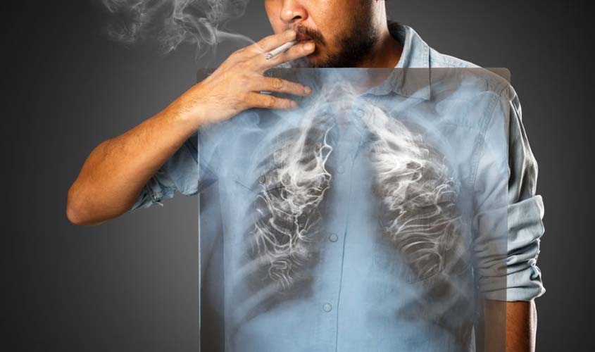 Dados mostram que 90% dos diagnósticos de câncer de pulmão estão relacionados ao fumo