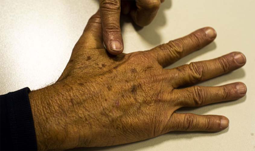 Sociedade médica lança campanha sobre prevenção do câncer de pele