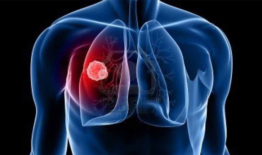 Câncer de pulmão é identificado em estágio avançado em 86% dos casos
