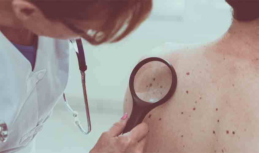 Tipo agressivo de câncer de pele é o segundo mais comum entre os não melanoma