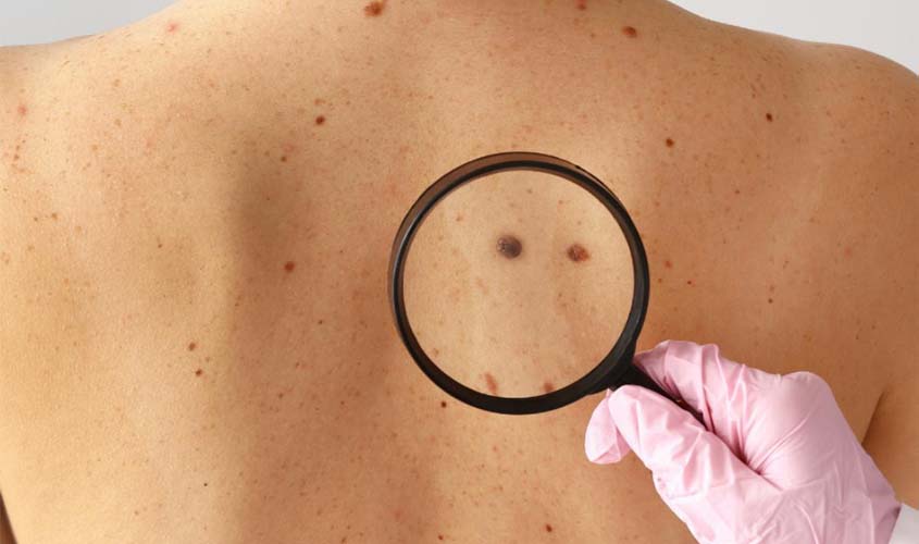 Câncer mais comum no país ainda é cercado de mitos