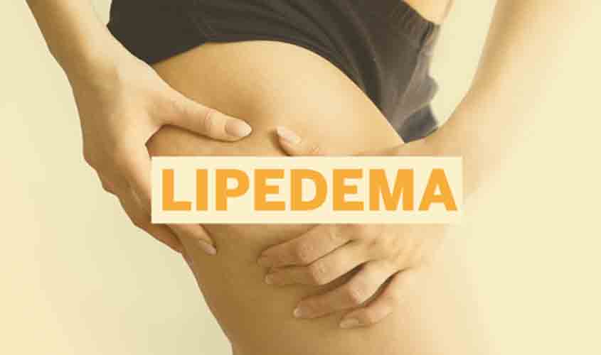 Lipedema: mais de 10 milhões de brasileiras podem ter a doença e não sabem