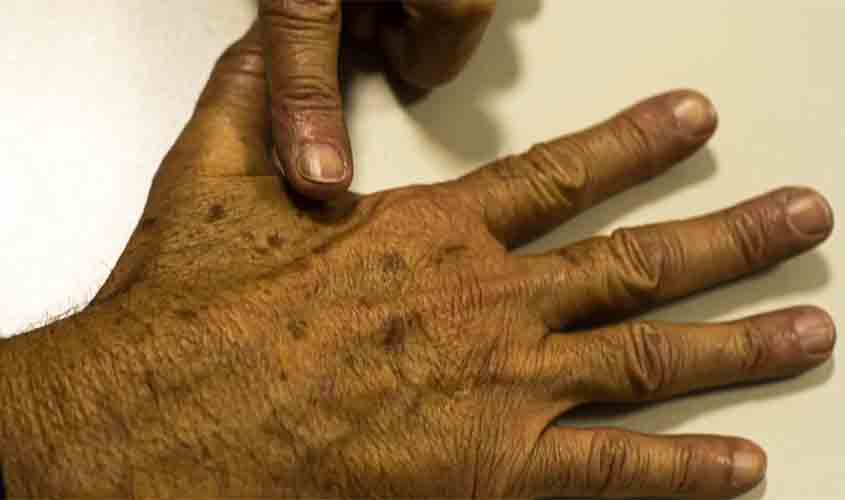 Verão acende alerta para câncer de pele: tecnologia aprimora diagnóstico precoce