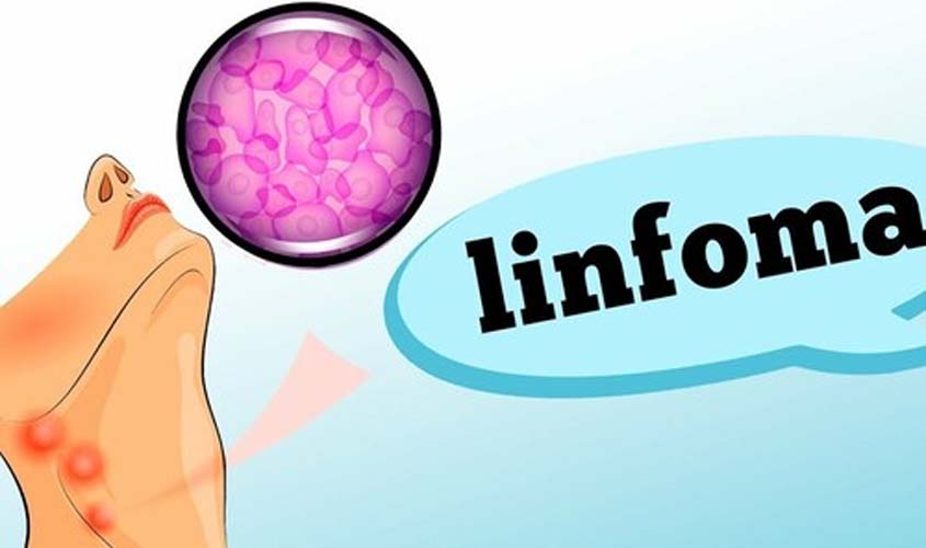 O que é Linfoma? Descubra sintomas e sinais de alerta