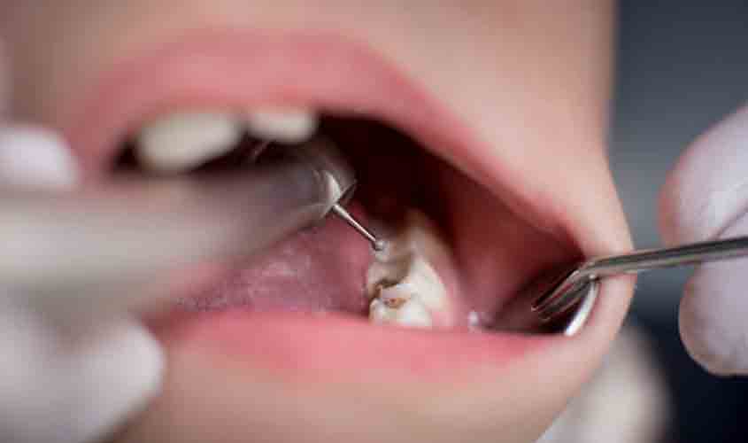 Quanto tempo a cárie demora para destruir o dente e como evitar