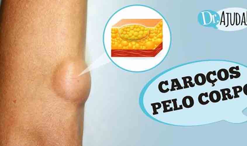 Caroços pelo corpo e lipoma: O que são? O que reparar?