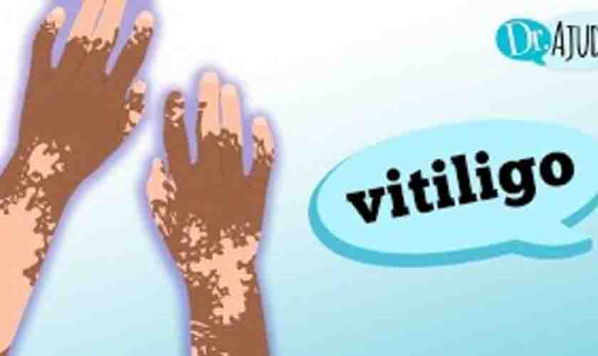 Vitiligo: o que é vitiligo e quando suspei