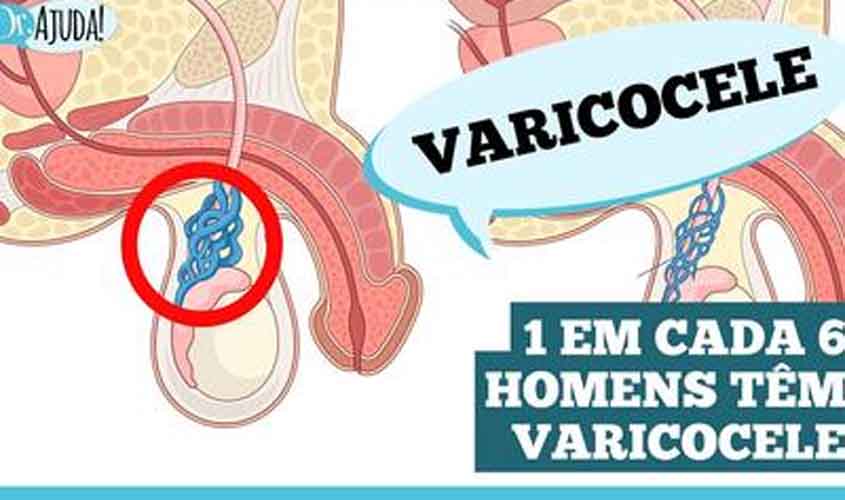 Varicocele: o que é importante saber?