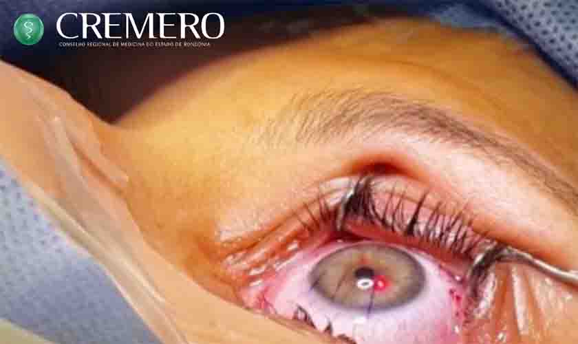 Fiscalização do Cremero confirma surto de infecção pós mutirão de cirurgias oftalmológicas