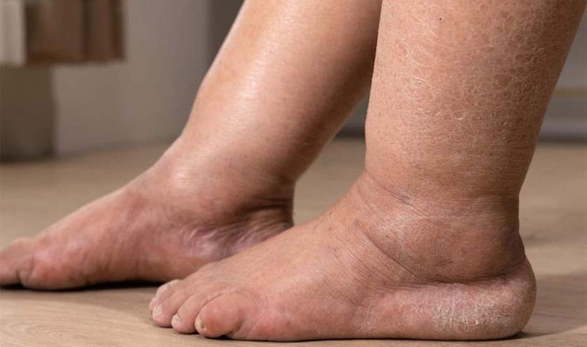 Inchaço nas pernas pode ser lipedema ou linfedema: saiba como identificar