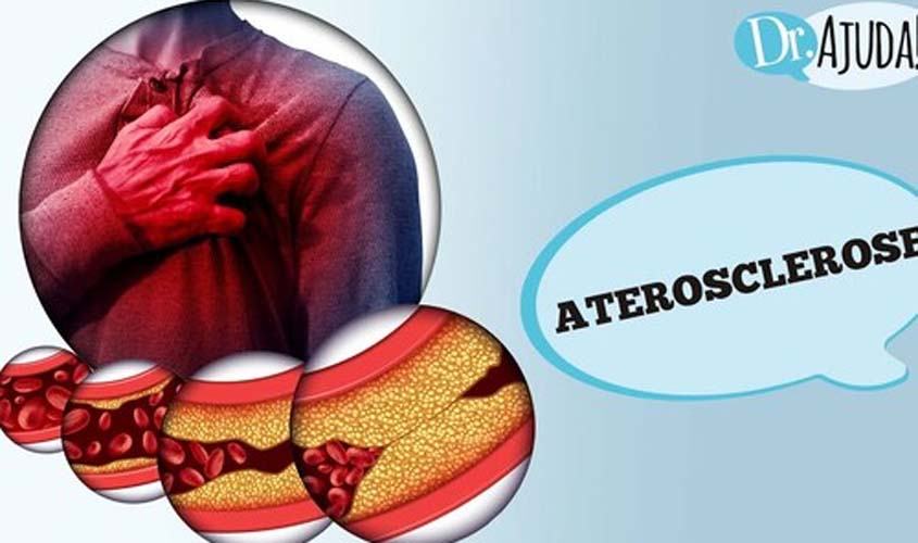 O que é aterosclerose? Quais os sintomas e os fatores de risco?