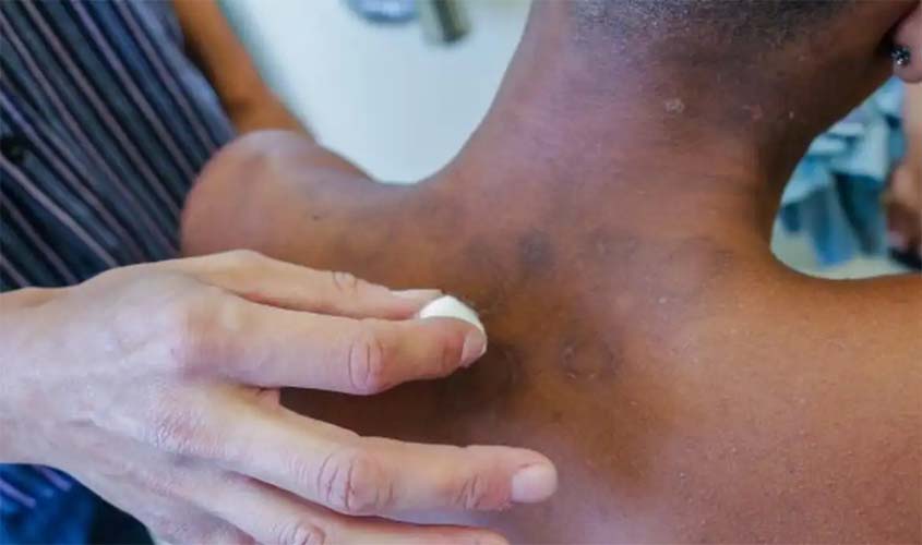 Novos casos de hanseníase aumentaram 5% de janeiro a novembro de 2023