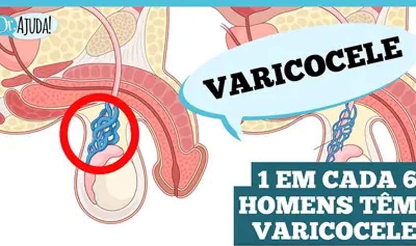 Varicocele: o que é importante saber?