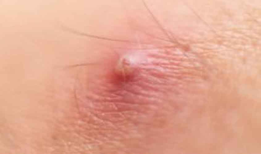 Furúnculo pode matar? Dermatologista explica os perigos da manipulação caseira da infecção