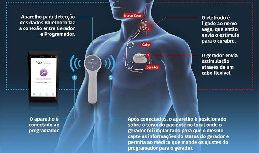 Pacientes com epilepsia resistente a medicamentos aguardam SUS disponibilizar terapia que teve sua incorporação determinada pelo Ministério da Saúde há cinco anos