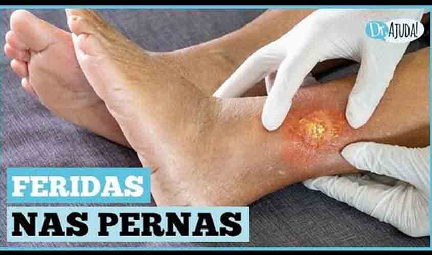 DR. AJUDA: O que causa as feridas nas pernas e nos pés?