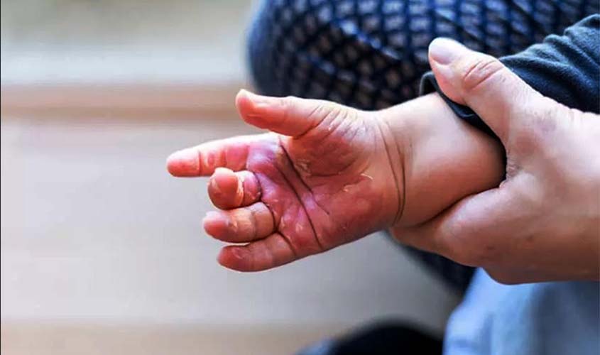 Rondônia registra 22 casos de queimaduras em crianças pequenas