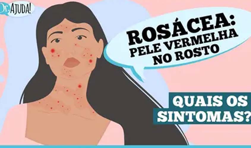 Rosácea: o que é e quais são os sintomas