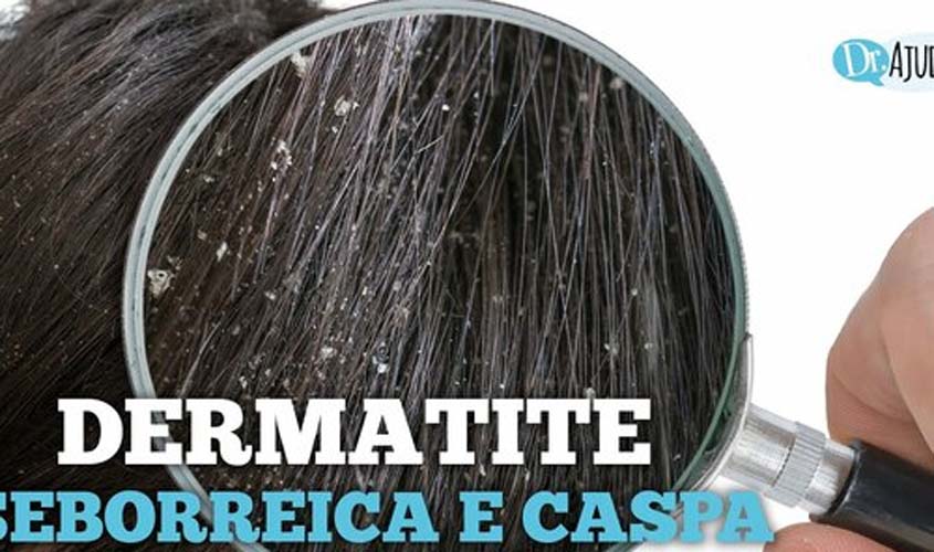 Dermatite seborreica: Quais são as causas? O que fazer?