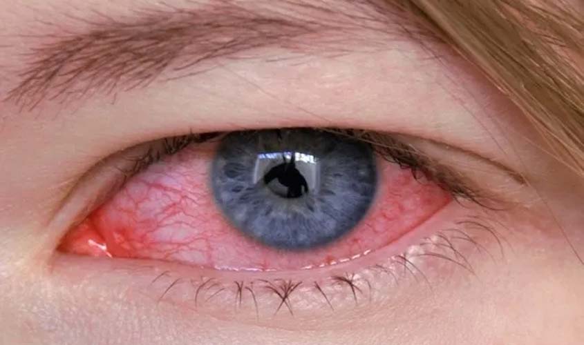 Vermelhidão nos olhos é o principal motivo de urgências oftalmológicas, mostra pesquisa