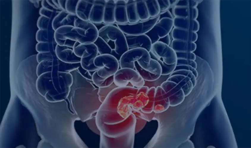 SUS pode implementar rastreamento de câncer colorretal