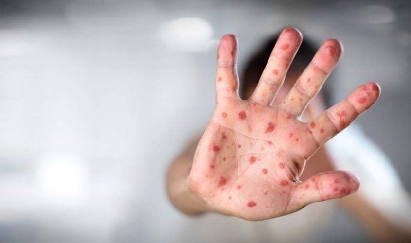 OMS alerta para recorde de casos de sarampo na Europa