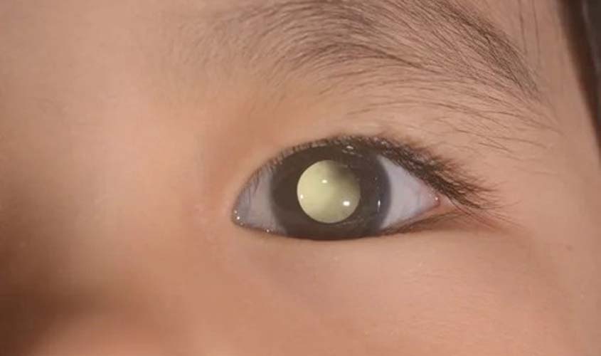 Retinoblastoma: no mês de combate ao câncer infanto-juvenil, campanha dá oportunidade de diagnóstico precoce