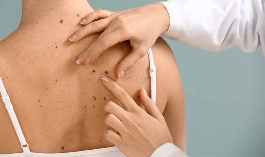 Câncer de pele: saiba como identificar os sinais e agir preventivamente  