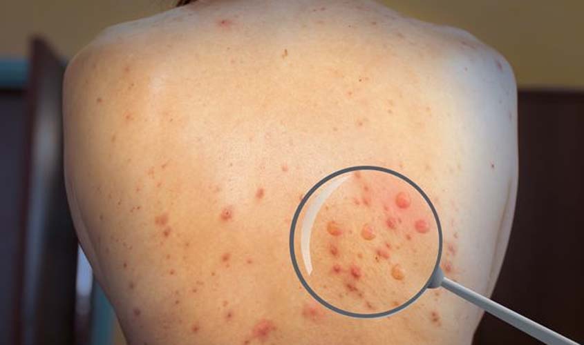 Brasil registra mais de 50 casos de varíola do macaco; 4 em Porto Velho