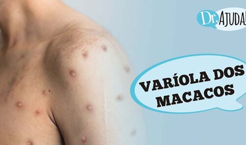 Varíola dos macacos: sintomas e prevenção