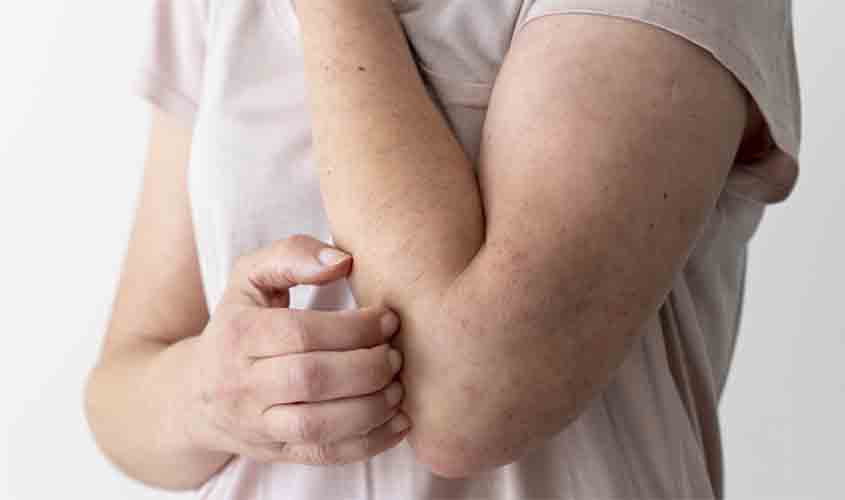 Hanseníase: sintomas iniciais podem ser confundidos com outras doenças