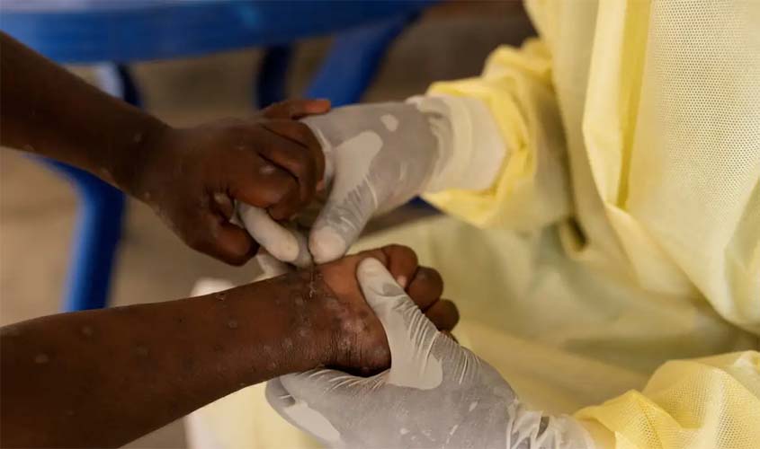 Brasil registra 88 casos de mpox em 2026; veja como prevenir