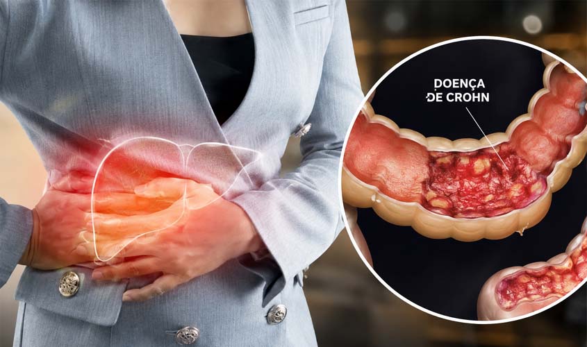 Do sofrimento à recuperação: novos tratamentos transformam a vida de pacientes com doença de Crohn