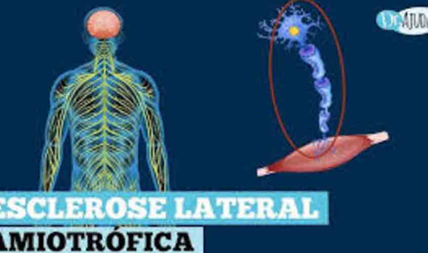 Dr. Ajuda: Esclerose Lateral Amiotrófica; diagnóstico, sintomas, causas e tratamento