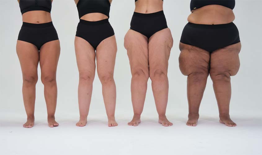 Lipedema: como o diagnóstico precoce evita a progressão