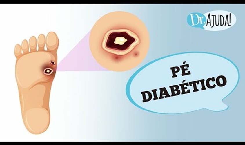 Pé diabético: prevenção e tratamento