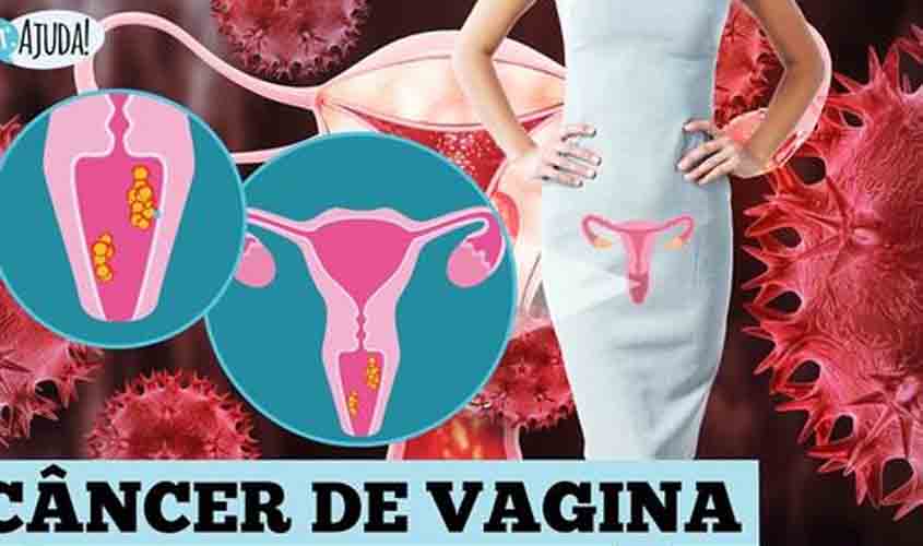 Câncer de vagina: quais o sintomas, prevenção e tratamento