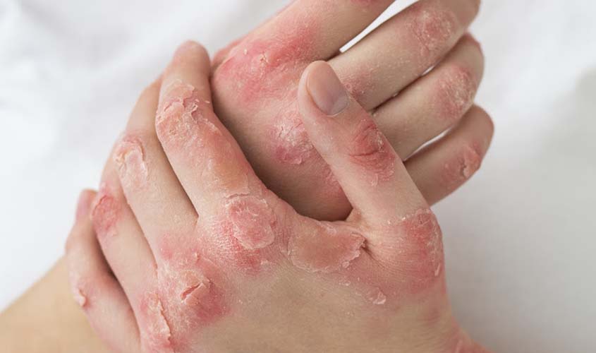 Psoríase: dermatologistas alertam para diagnóstico precoce
