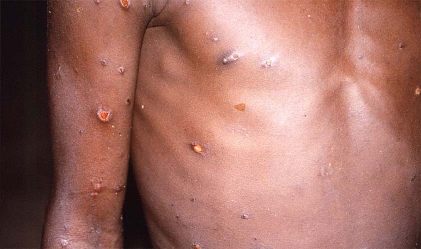 Saúde monitora dois casos suspeitos de varíola dos macacos