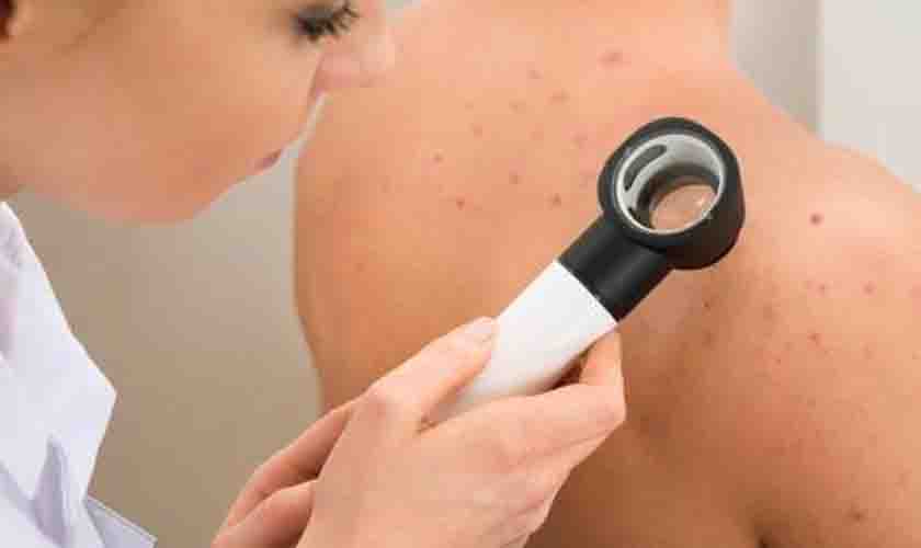Câncer de pele é o mais comum no Brasil
