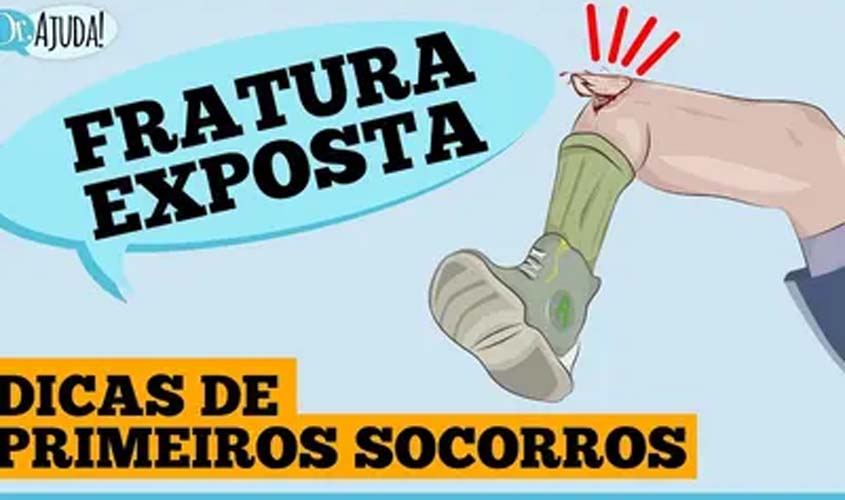 Fratura exposta: dicas de primeiros socorros